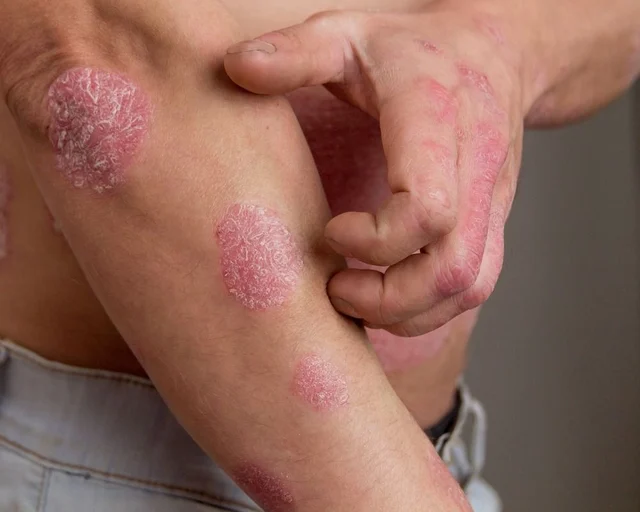 SRIMAYAM AYURVED - Psoriasis treatment in Gujarat - 2