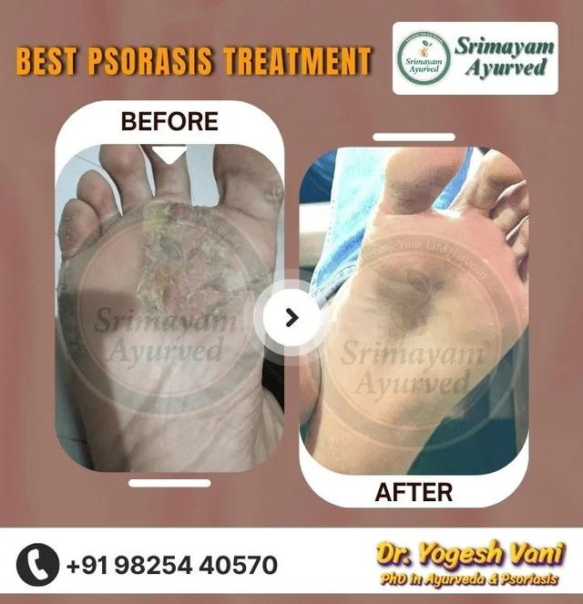 SRIMAYAM AYURVED - Psoriasis treatment in Gujarat - 3